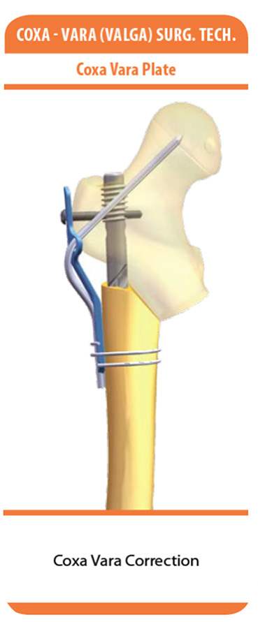 Kinetics Plus - Pega Medical implantes ortopédicos especialistas en Traumatología infantil